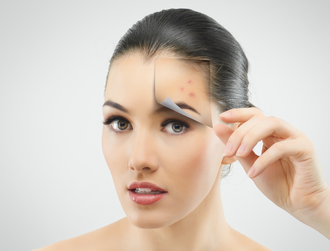 Chemical Exfoliation For Acne Wigmore Medical