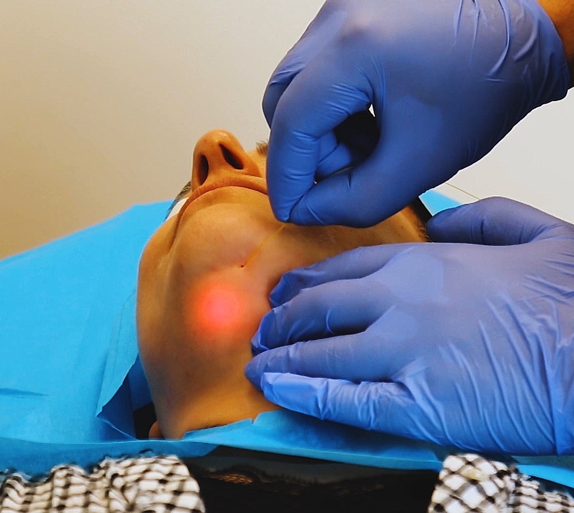 Endolift Process Wigmore Medical